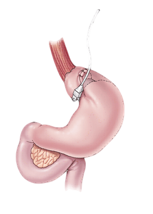 Gastric-Band-Surgery-Puerto-Vallarta