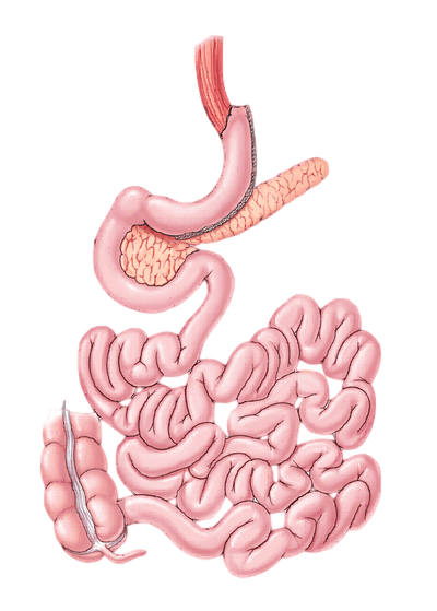 Vertical-Sleeve-Gastrectomy-in-Puerto-Vallarta